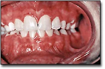 Gingiva - Normal Gingiva in Mixed Dentition