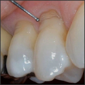 Gérer l’érosion dentaire 