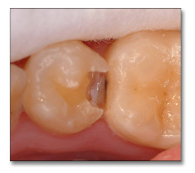Surfaces at Risk for Caries - Figure 7
