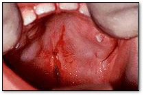 Soft Tissue Trauma - Soft Tissue Trauma of the Palate