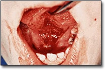 Ankyloglossia - Figure 3