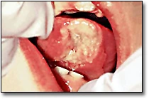 Natal Teeth - Riga-Fede Disease Ulceration
