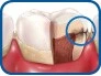 Patient Material - ¿Cómo se producen las caries? - How Do You Get Cavities? - Spanish - Image 6