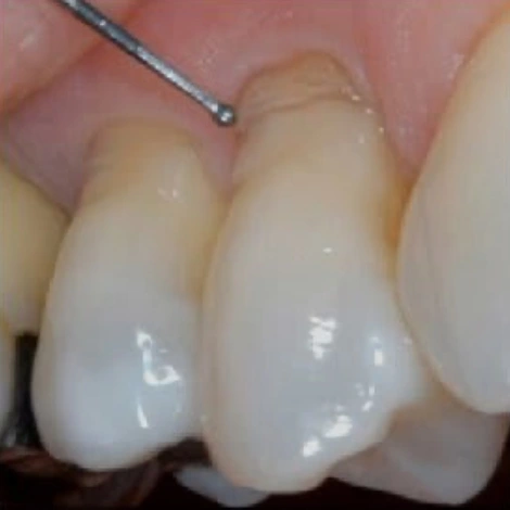 CE 517 Dental erosion, fluoride, stannous fluoride, caries, saliva