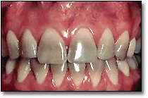 La décoloration des dents - Figure 4