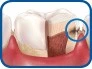 Patient Material - ¿Cómo se producen las caries? - How Do You Get Cavities? - Spanish - Image 5