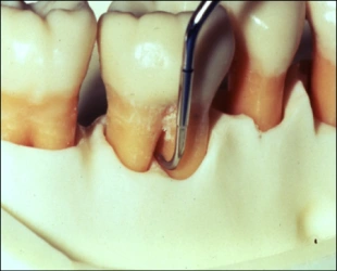 La figure 23 est un gros plan des molaires avec un instrument dentaire sondant la base d’une dent