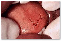 Soft Tissue Trauma - Laceration of Tongue