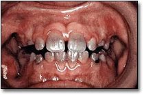 Discolored Teeth - Figure 6