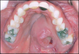 image d’un adénocarcinome polymorphe d’évolution lente