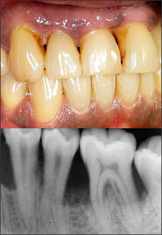 Steps for Determining a Diagnosis of Periodontitis - Figure 4