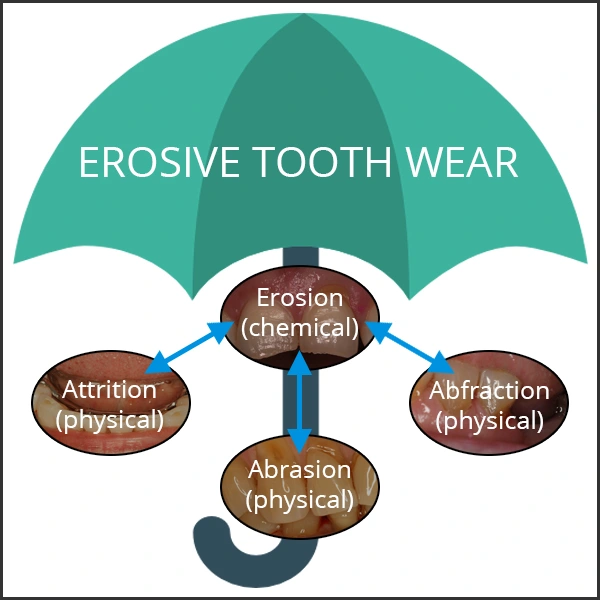 Diagram showing different kinds of erosive tooth wear (ETW).