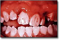 Displaced Permanent Teeth - Extruded Permanent Teeth