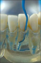 La figure 9 montre un modèle de dents avec des gencives translucides que l’on sonde au moyen d’un instrument dentaire
