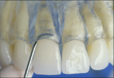 La figure 32 montre une curette Langer 5/6 sur les dents antérieures et les prémolaires