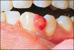 Pyogenic granuloma