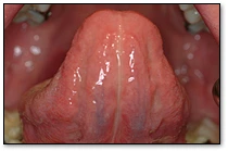 Tongue - Ventral Surface
