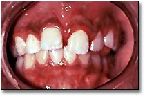 Le déplacement de dents permanentes - Figure 1