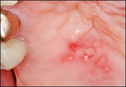 Images de gingivo-stomatite herpétique primaire