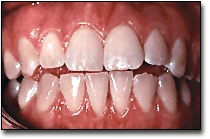 La forme des dents - les dents permanentes