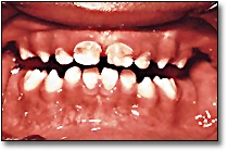 Early Childhood Caries (Patterns of Decay) - Figure 3