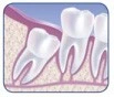 Wisdom Teeth Pain and Removal - Image01
