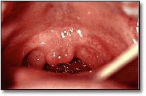 Submucous Clefts