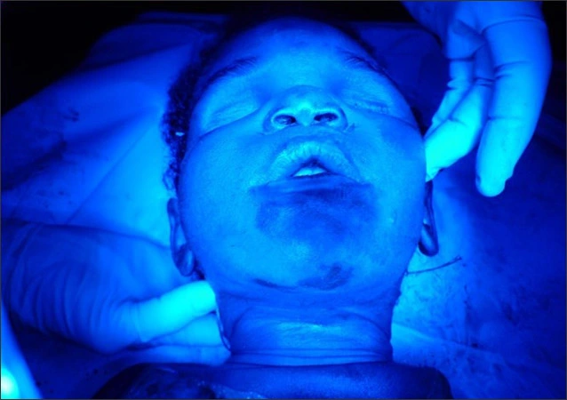 Photo showing injuries photographed using 425nm blue light narrow band illumination highlighting the extent of the massive bruising the child sustained