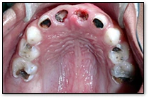Early Childhood Caries (Patterns of Decay) - Figure 4