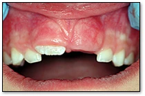 Modèle d’éruption - Dents permanentes - Figure 3