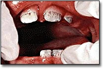 Discolored Teeth - Figure 10