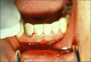Figure 54 : un détartreur Nevi 1 - extrémité faucille utilisée dans une bouche