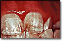 Discolored Teeth - Fluorose légère