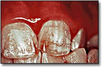 La décoloration des dents - Fluorose modérée