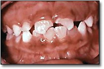Dental Fractures - Figure 2