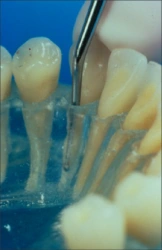 La figure 39 montre une curette de débridement 7/8 sondant un modèle de dents et de gencives