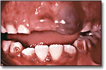 Eruption Hematomas - Figure 2