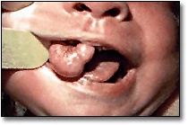 Congenital Epulis of the Newborn - Figure 2