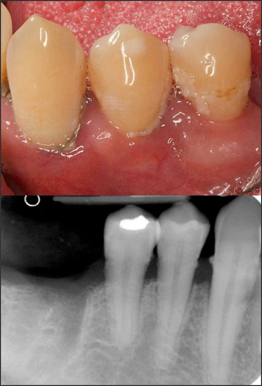 Photo and x-ray showing Stage 1 Grade B periodontitis