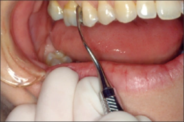 La figure 13 est une photo de la bouche d’un patient sondé avec une curette Gracey 11/12