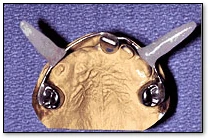 Oral Electrical Injuries - Commissure Splint