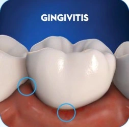 Gingivities