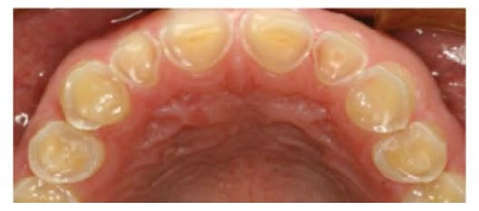 Severe palatal erosion and loss of tooth structure. Courtesy of Prof. Ian Meyers