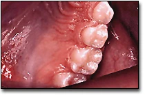 Alveolar Mucosa - Palatal Aspect