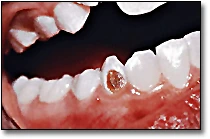 Smooth Surface Caries - Figure 1
