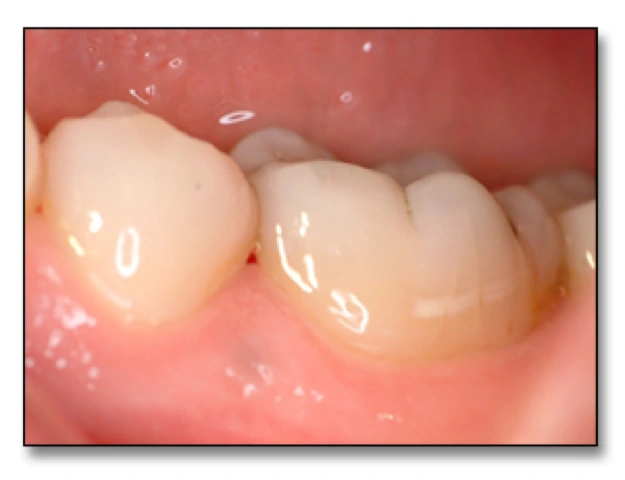  Surfaces at Risk for Caries - Figure 4