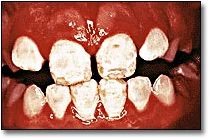 La décoloration des dents - Figure 3