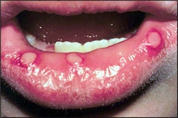Images de gingivo-stomatite herpétique primaire
