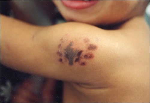 La photo montre une agression sur un enfant par un autre enfant dans une garderie, avec la trace d’une morsure pédiatrique sur la victime.