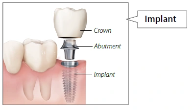 Dental Implants Home